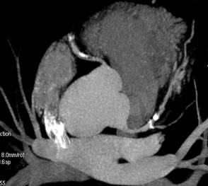 Calcificazioni Coronariche e Calcium Score - Prevenzione Cardiovascolare